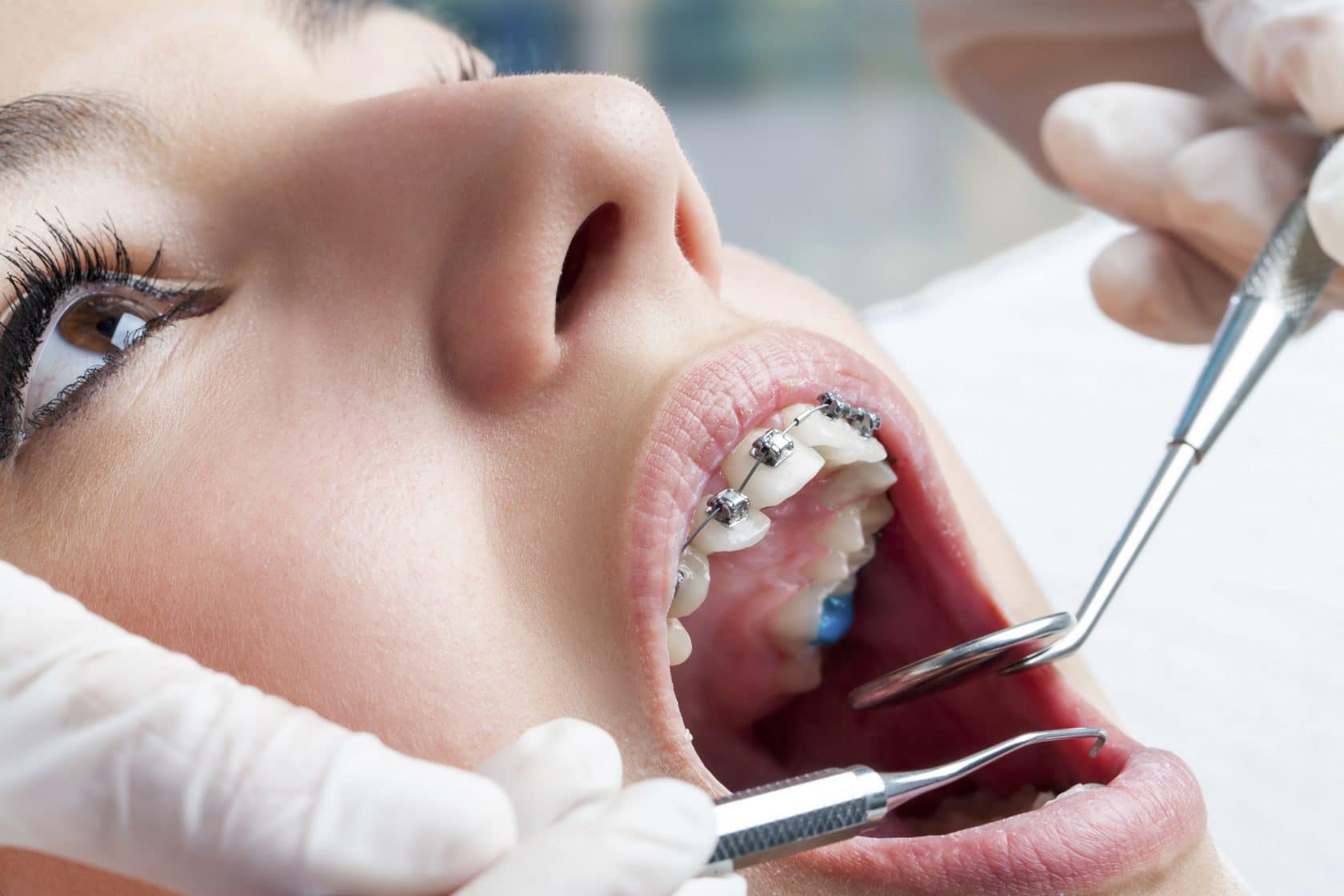 Dental Care With Braces