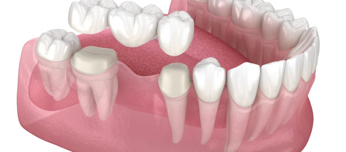 Gum Pain around a Dental Bridge
