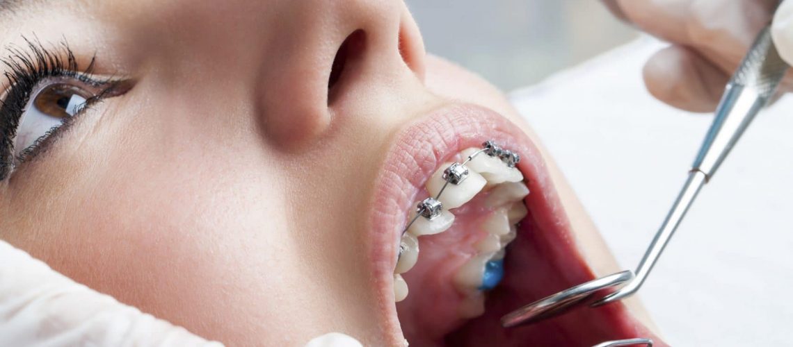 Dental Care With Braces